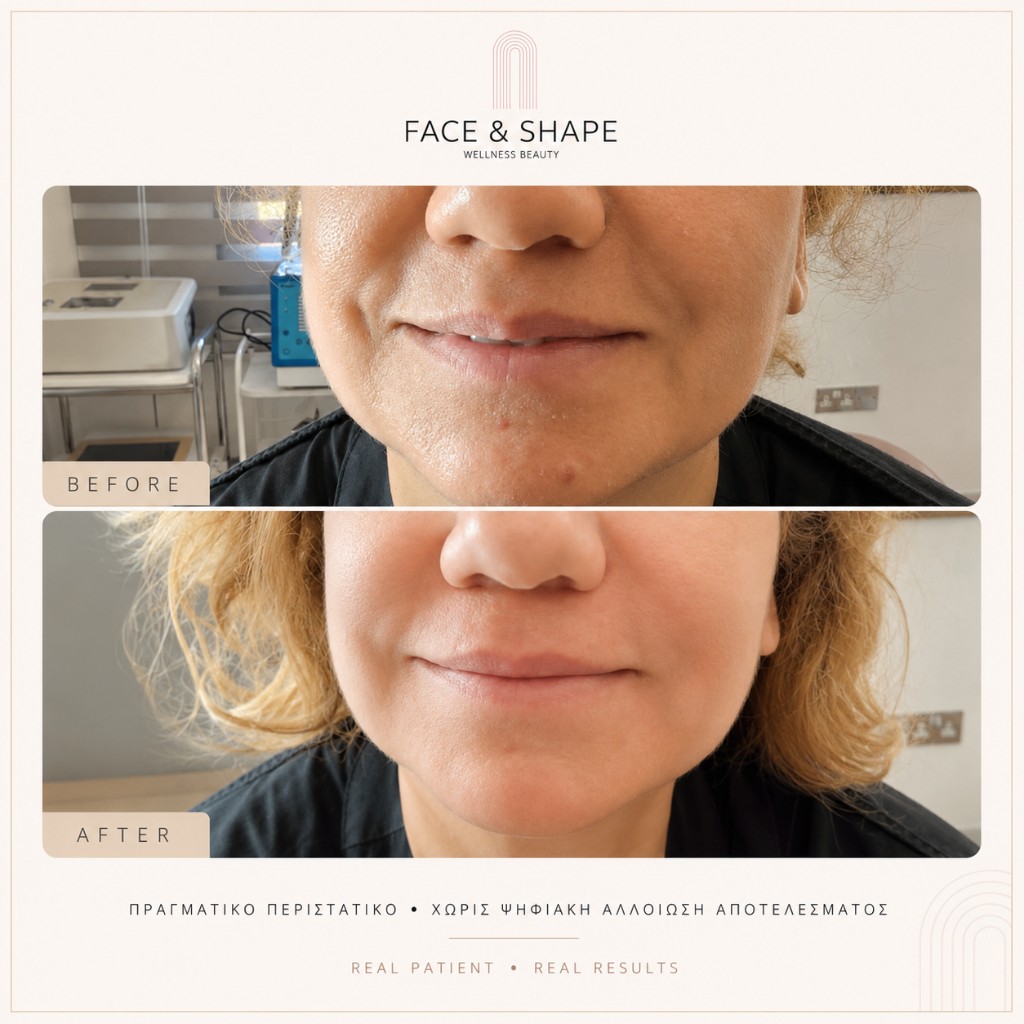 Before & After, βελτίωση υφής δέρματος
