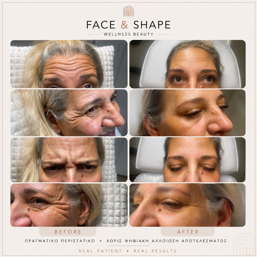 Before & After, Botox ρυτίδες έκφρασης